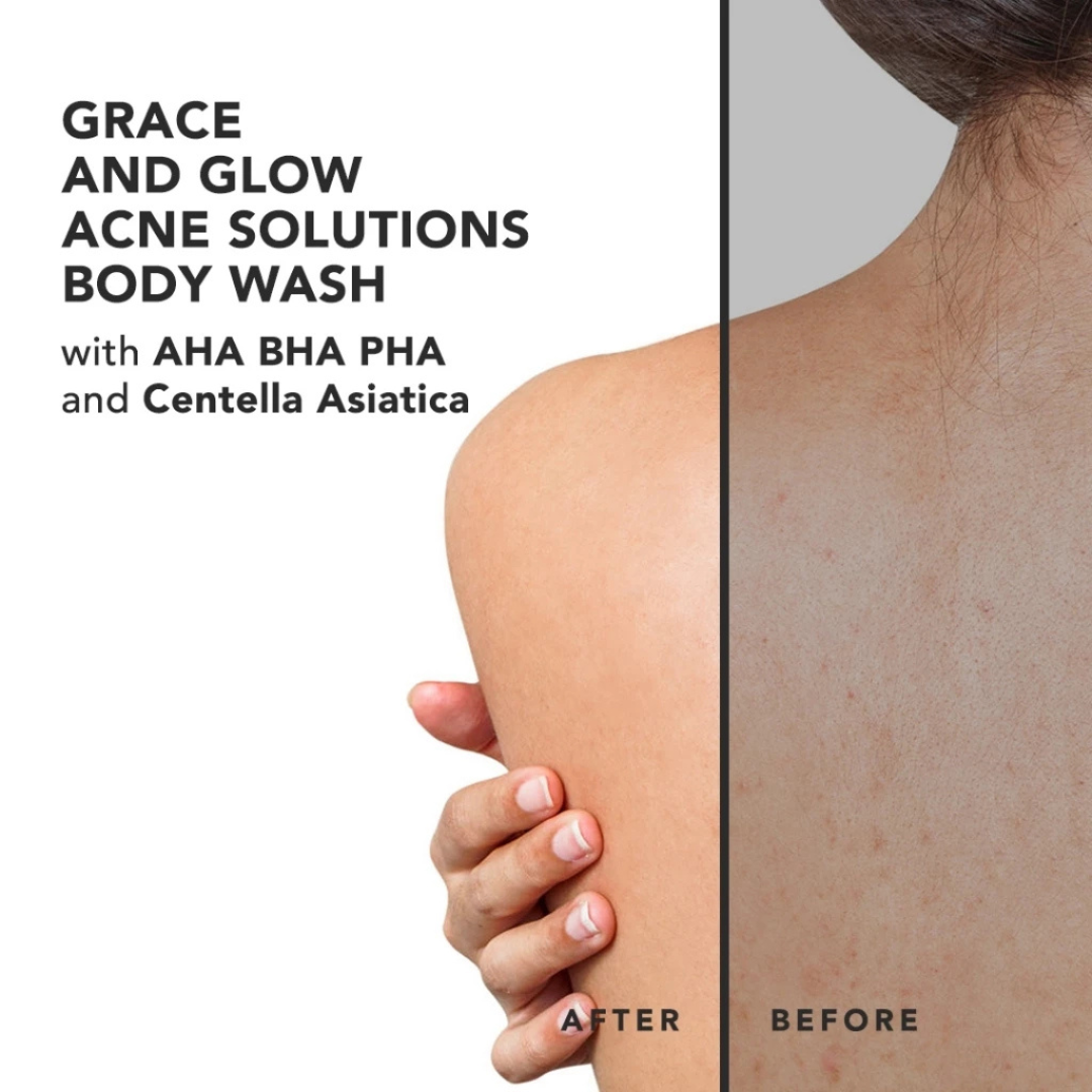 GRACE AND GLOW Anti Acne Solution Body Wash (AHA BHA PHA + Centella Asiatica) 400ml