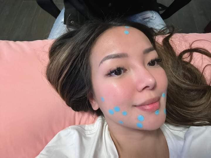 Rosmar Hydrocolloid Pimple Patch