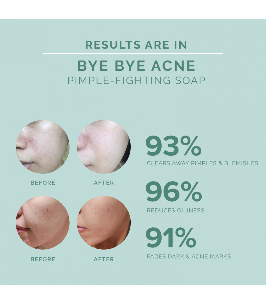 Seoul White Korea Bye Bye Acne Bright & Clear Pimple-Fighting Bar Soap 60g